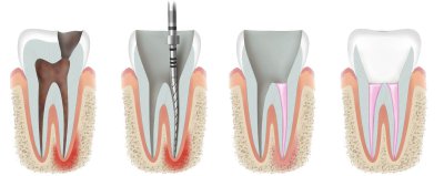 Endodontie